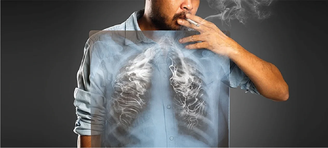Smoking and Lung Cancer